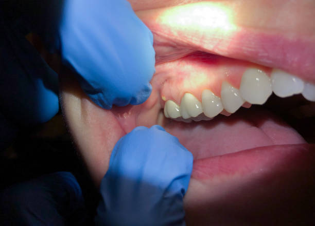 Best Emergency Dentist for Lost Fillings or Crowns in Beverly Hills, MI